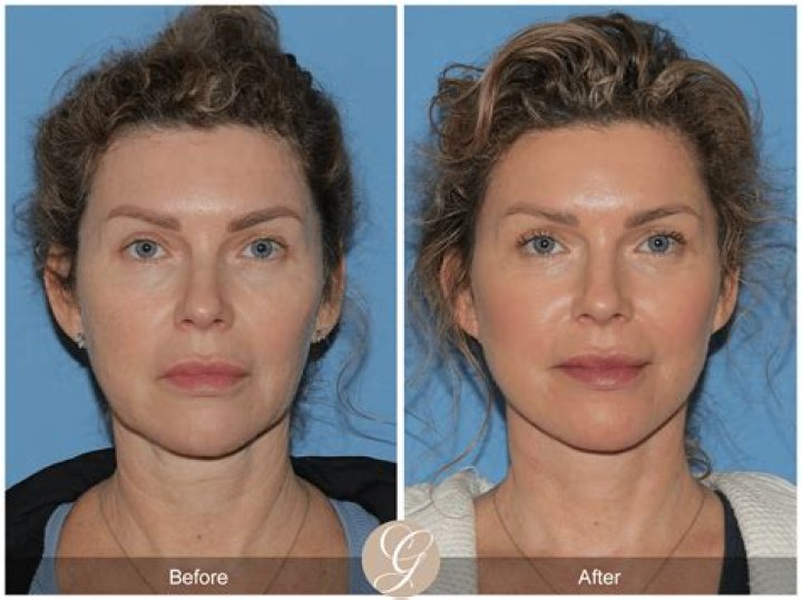 Amy Poehler Underwent Facelift Surgery? Before and After Images